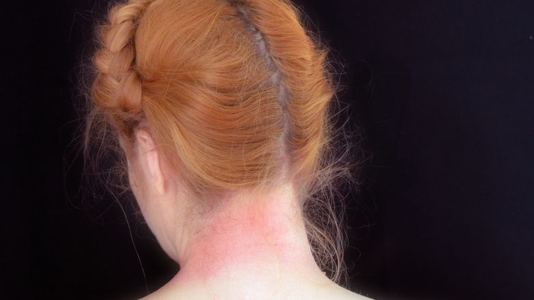 Photo of artwork by Heather Sincavage, showing back of woman's head with red mark on neck